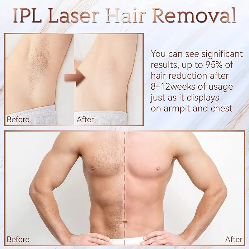 IPL Laser Epilator